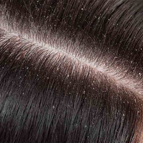 Hair Scalp & Dandruff Treatment