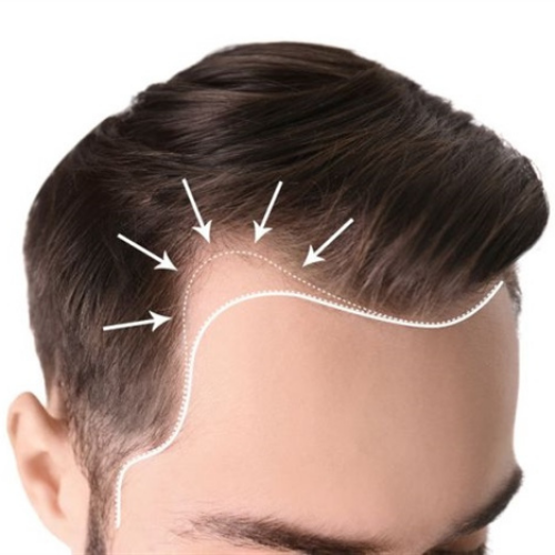 Hairline Reconstruction